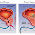 Προστατίτιδα και Προστάτης 