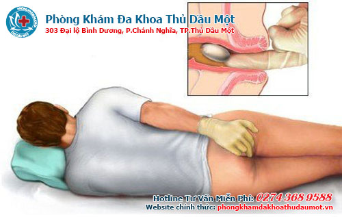 Khám bệnh trĩ ở đâu tại Bình Dương