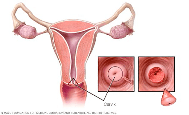 cervical-cancer-cure-rate