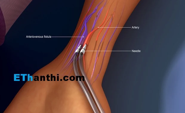 சிறுநீரகநோய் மற்றும் இரத்த சுத்திகரிப்பு முறை !