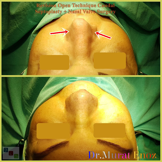 caudal septum deviation, anterior septal dislocation,caudal septal dislocation,  caudal septoplasty,Nasal valve collapse surgery,