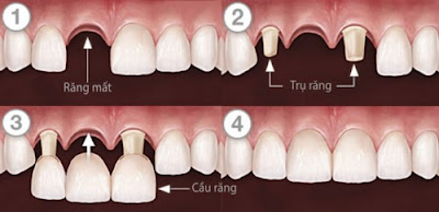 Chuyên gia giải đáp trồng răng giả cố định giá bao nhiêu 1