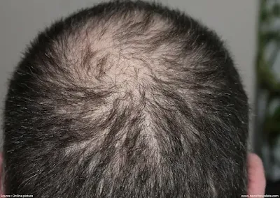 Hair Loss