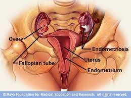 Pengobatan Alternatif Kista Endometriosis