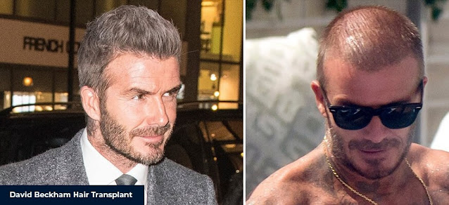 David Beckham ha subito un trapianto?