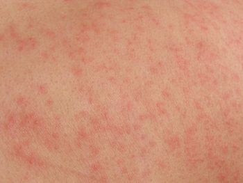 Common Fungal Rashes and Infections