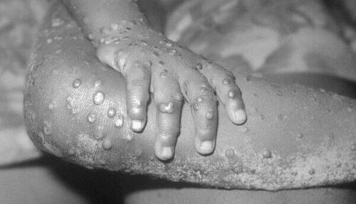 Should I Be Worried About Monkeypox?