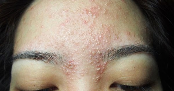 Tratamento facial causa alergia e deforma rosto de