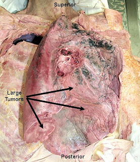 Cancer and its treatment