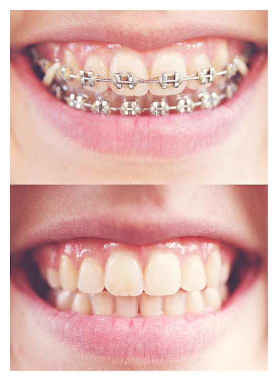 How Much Do Braces Hurt on a Scale 1-10 | Do Braces Hurt?