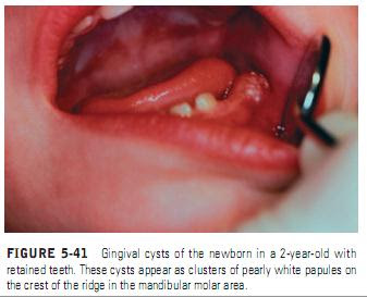 GINGIVAL AND PALATAL CYSTS OF THE NEWBORN AND ADULT Features in the Newborn