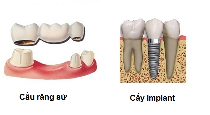 cay-ghep-rang-implant-nha-khoa-thuan-kieu-2016