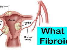 Cara Kecutkan Fibroid 