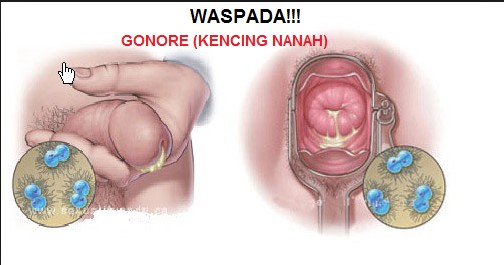 kencing nanah sembuh sendiri


