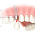 Chi phí trồng răng implant