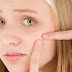 Simple tips to overcome acne