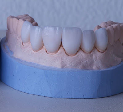 Khái niệm bọc răng sứ là gì