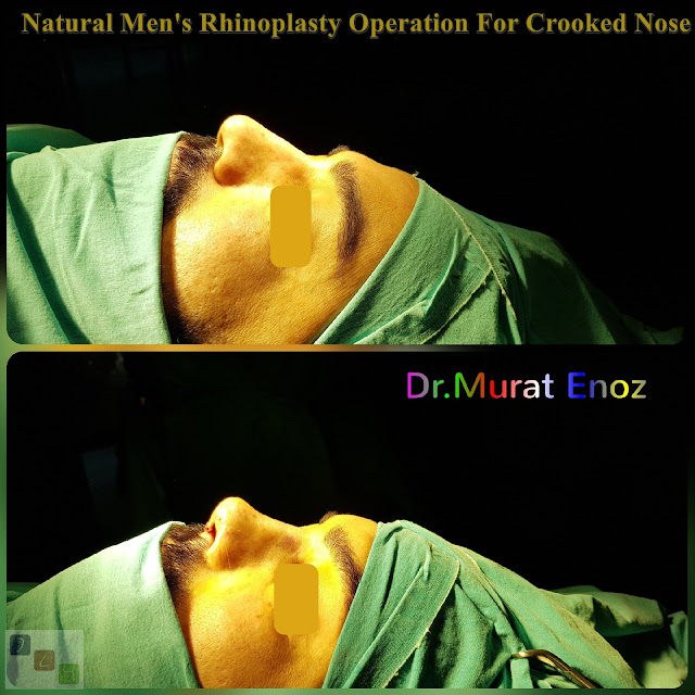 Natural Men's Nose Aesthetic Operation For Crooked Nose - Rhinoplasty For Men Istanbul - nose job,Natural rhinoplasty in Istanbul,Natural looking nasal aesthetic surgery,nose reshaping,