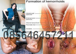 Apa Yang di Maksud Penyakit Hemoroid
