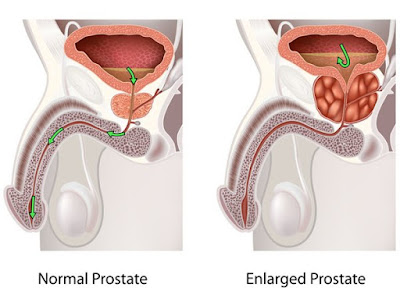 Benign Prostate Hyperplasia