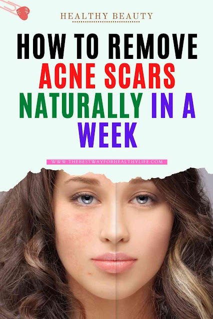 How to remove acne scars naturally in a week?