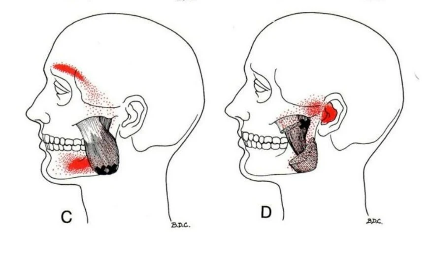 dolor cervical y dolor de cabeza - masetero - C y D - mc spa