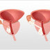 Stages of Prostate Cancer - Survival Rates.