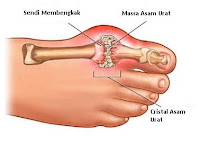 cara mengobati penyakit asam urat