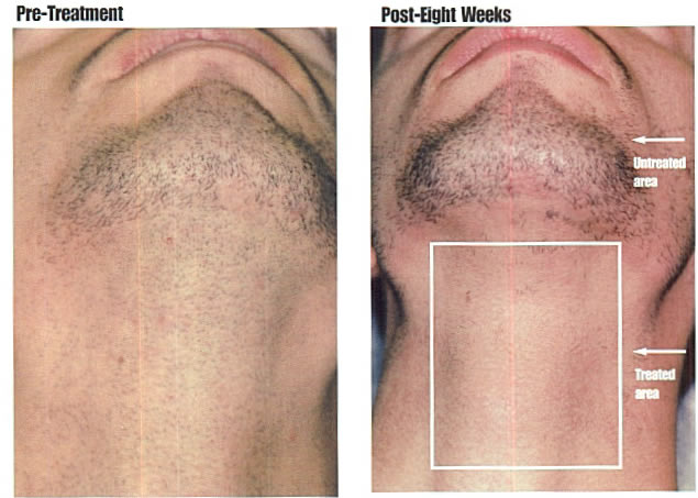 Permanent Hair Removal For Men - Hair Removal