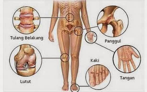 obat herbal penyakit asam urat asam urat atau artritis gout adalah 