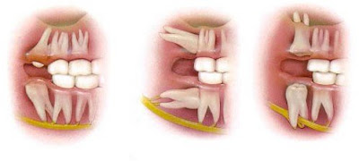 Răng khôn không mọc hết nên làm gì?