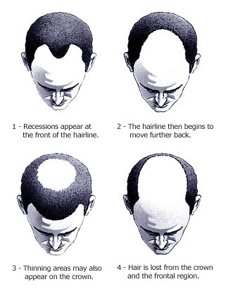 Pattern Baldness on Take Care For Baldness  Male Pattern Baldness   What Every Man Should