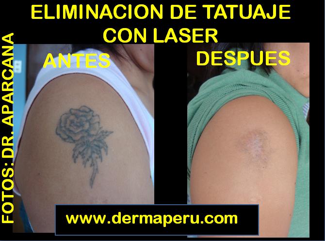 borrar tatuaje brazo. Borrar tatuajes de forma - Chase's Blog: borrar tatuajes