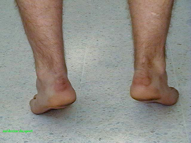 Examen clinique du pied et de la cheville