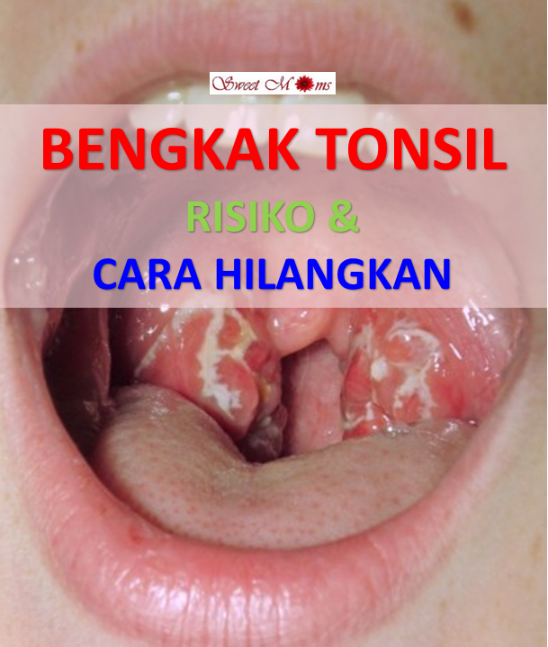 3 Cara Mudah Hilangkan Bengkak Tonsil, Elak Pembedahan 