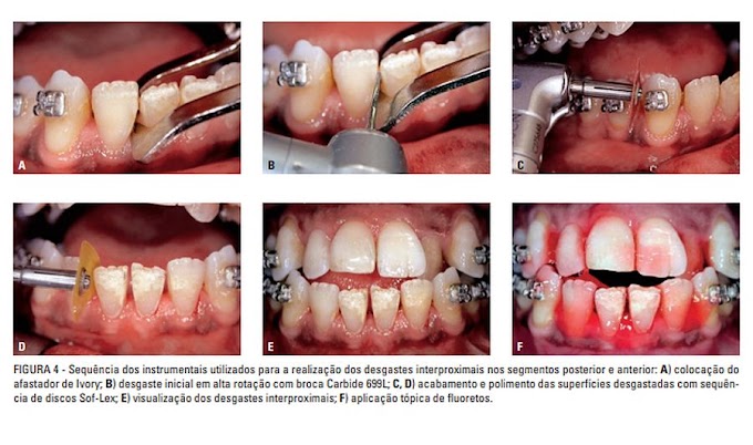 PDF: Redução de esmalte interproximal como alternativa no tratamento ortodôntico de casos limítrofes