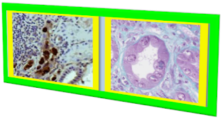 bk polyomavirus in solid organ transplantation bk polyomavirus bk polyomavirus treatment bk polyomavirus infection what is bk polyomavirus