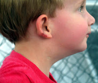 Brady's ear after surgery