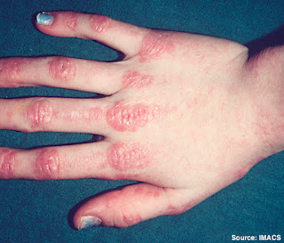 Dermatomyositis (DM)
