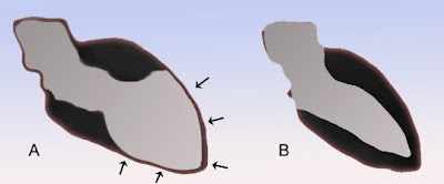 apical  balloning