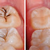 Răng dễ bị sâu khi nào?