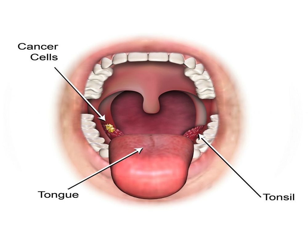 Dental Implants