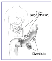 Drawing of the colon and an enlargement of it showing diverticula with colon (large intestine) and diverticula labeled.