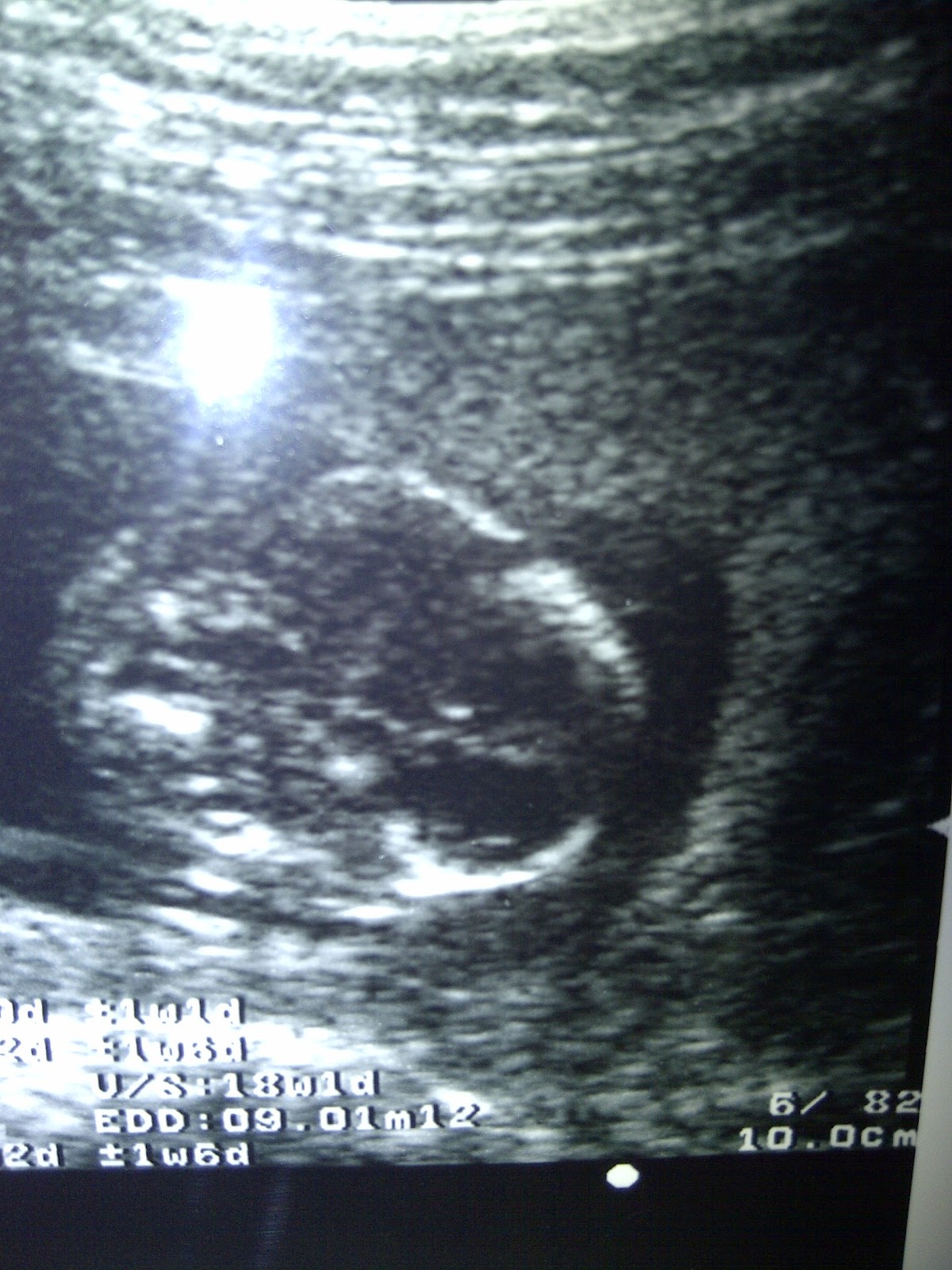 nathanaEL renantO 18 minggu kehamilan USG  2  Dimensi  