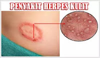 penyakit herpes