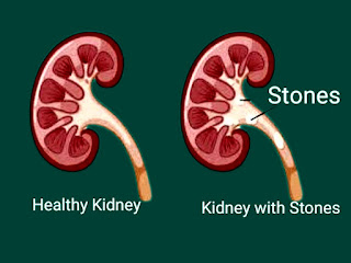 Kidney Stone Symptoms