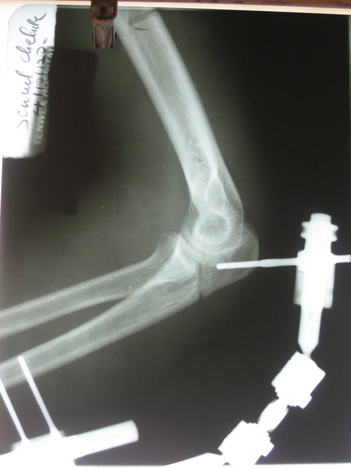 is one more follow-up. Earlier I showed a 3 month old ankle fracture -1.bp.blogspot.com