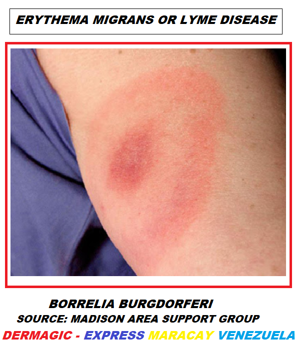 Eritema migrans en brazo, Borrelia burgdorferi