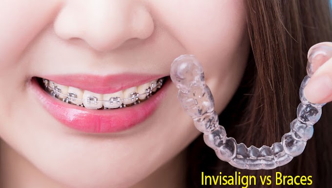 Invisalign vs Braces Best Answer and Solution