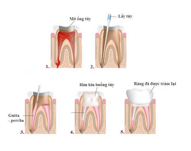 Thời gian điều trị tủy nha phụ thuộc trực tiếp vào các yếu tố như vị trí răng, cấu trúc răng…